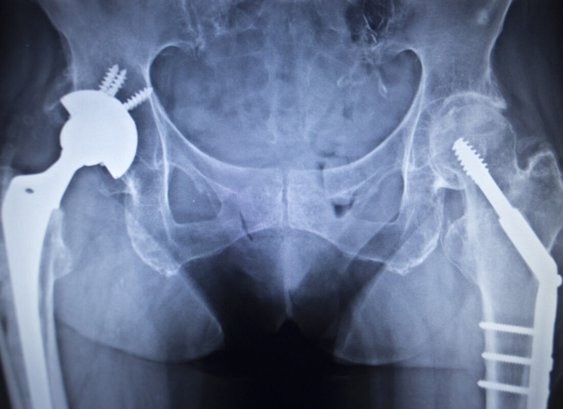 Röntgenbild eines Hüftgelenkersatzes beidseits mit Schraubenfixierung