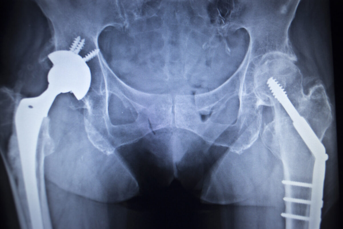 Röntgenbild eines Hüftgelenkersatzes beidseits mit Schraubenfixierung