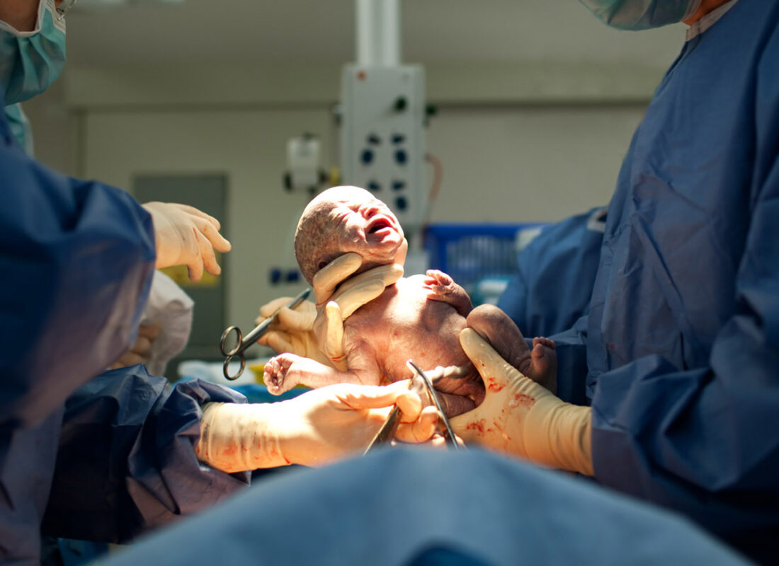 Ein Baby wird per Kaiserschnitt geboren