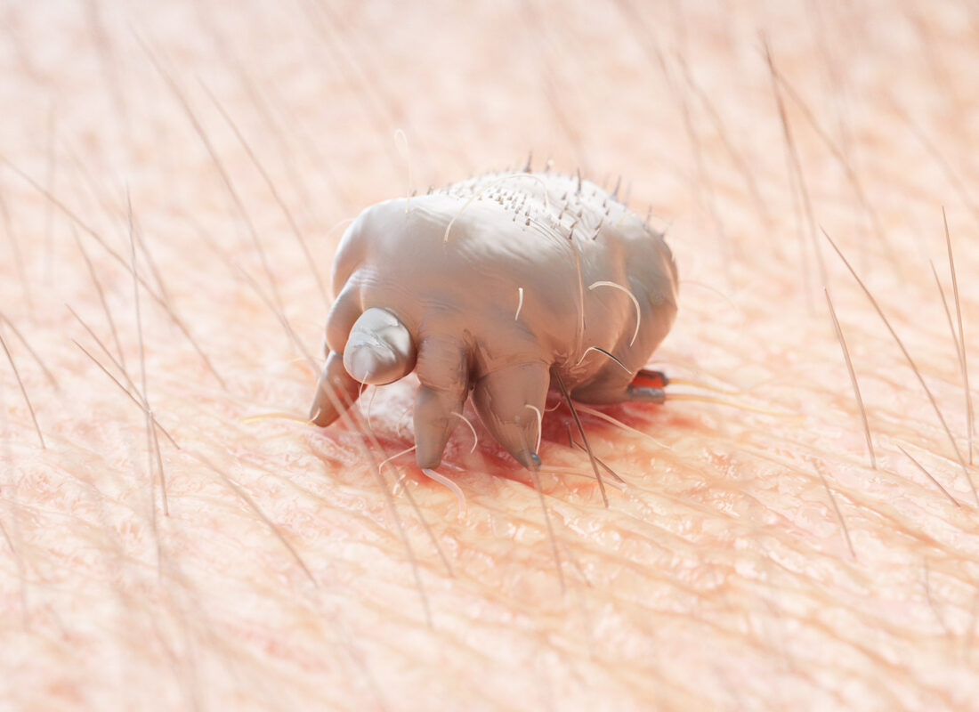 Naturgetreue Illustration einer Krätzemilbe (Scabies) auf der menschlichen Haut.