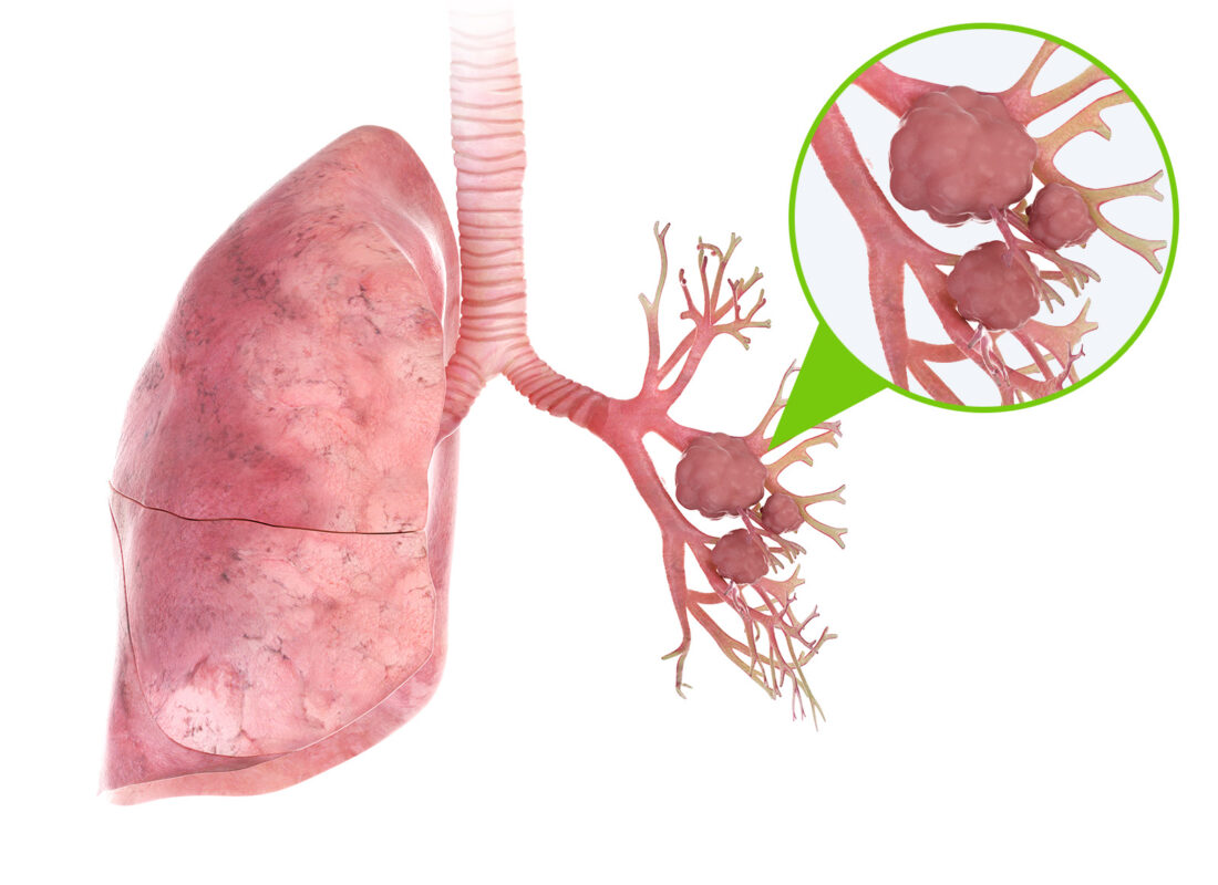 Die linke Lunge, vielmehr die Bronchien, sind von einekm Tumor befallen.