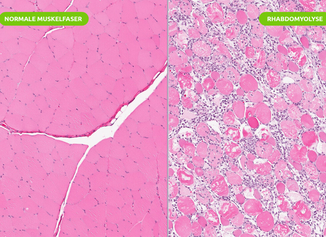 Rhabdomyolyse (Skelettmuskulatur)