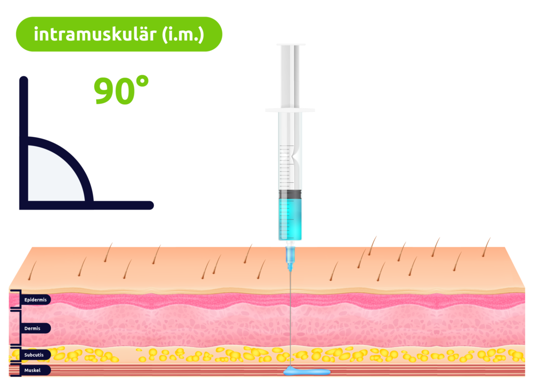 Intramuskuläre Injektion