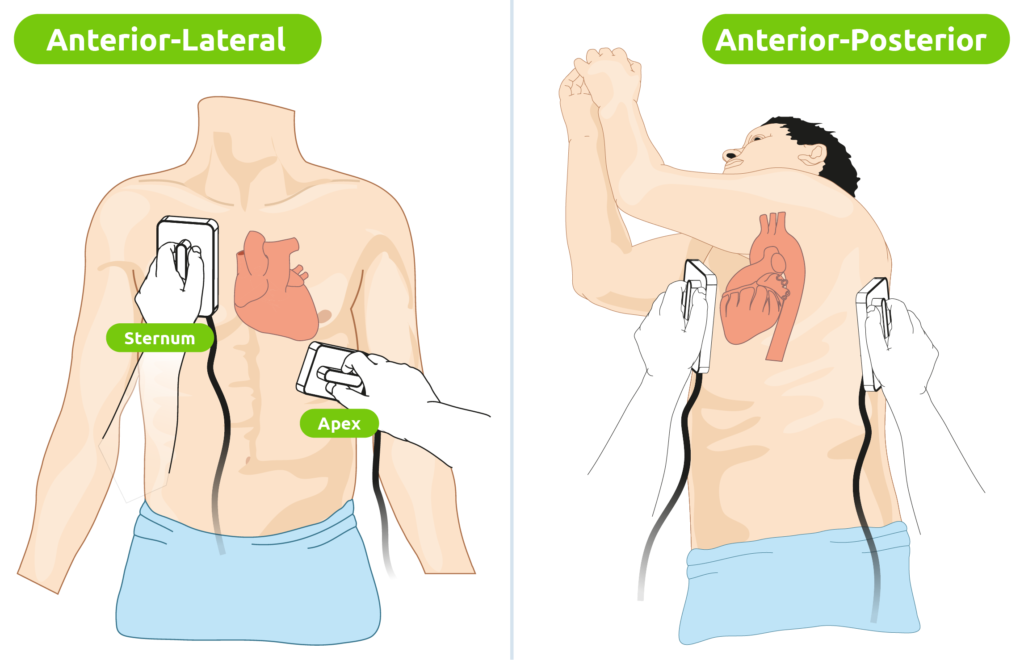 Positionierung der Defibrillator-Elektroden