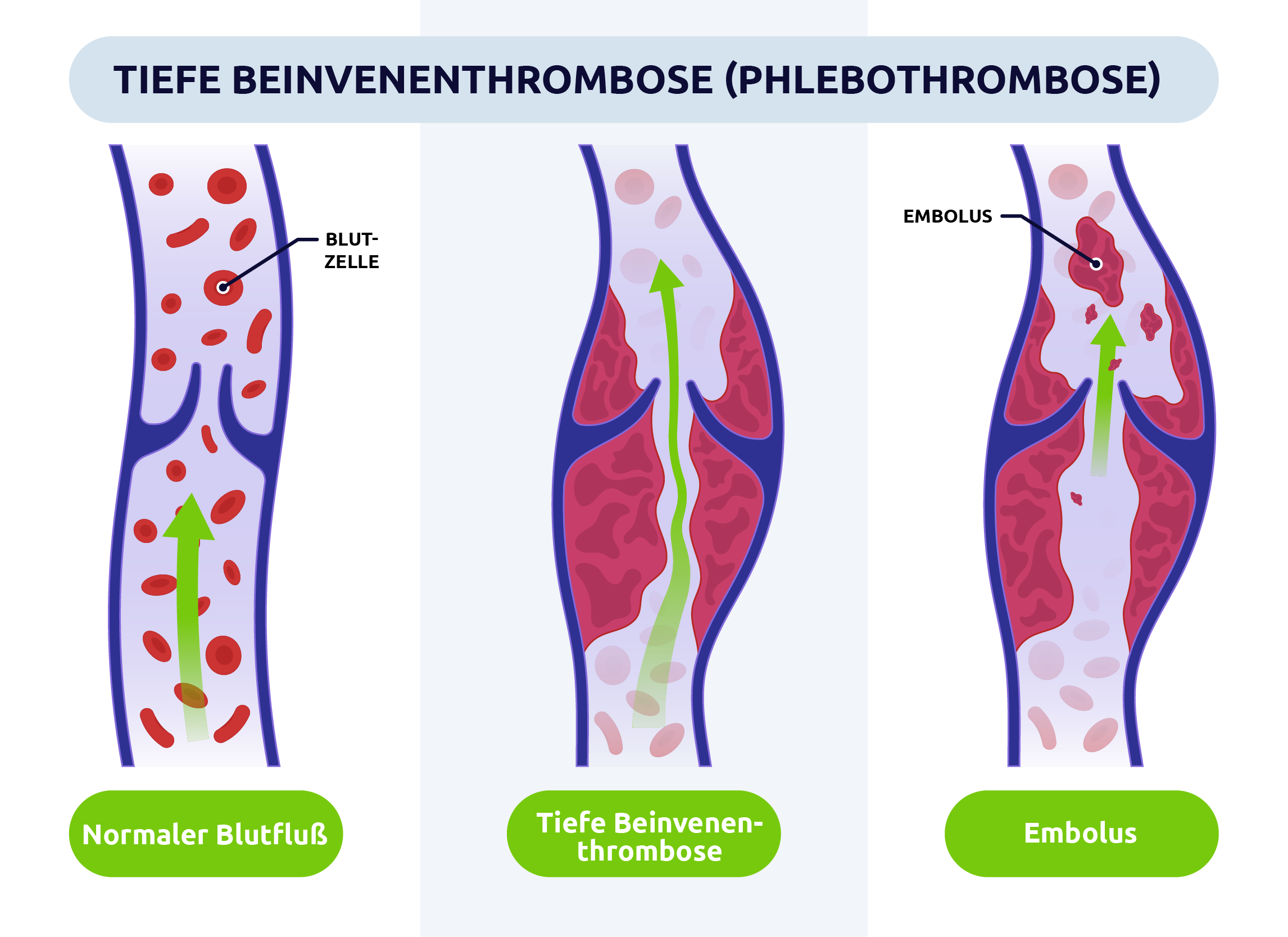 Tiefe Beinvenenthrombose (Phlebothrombose)