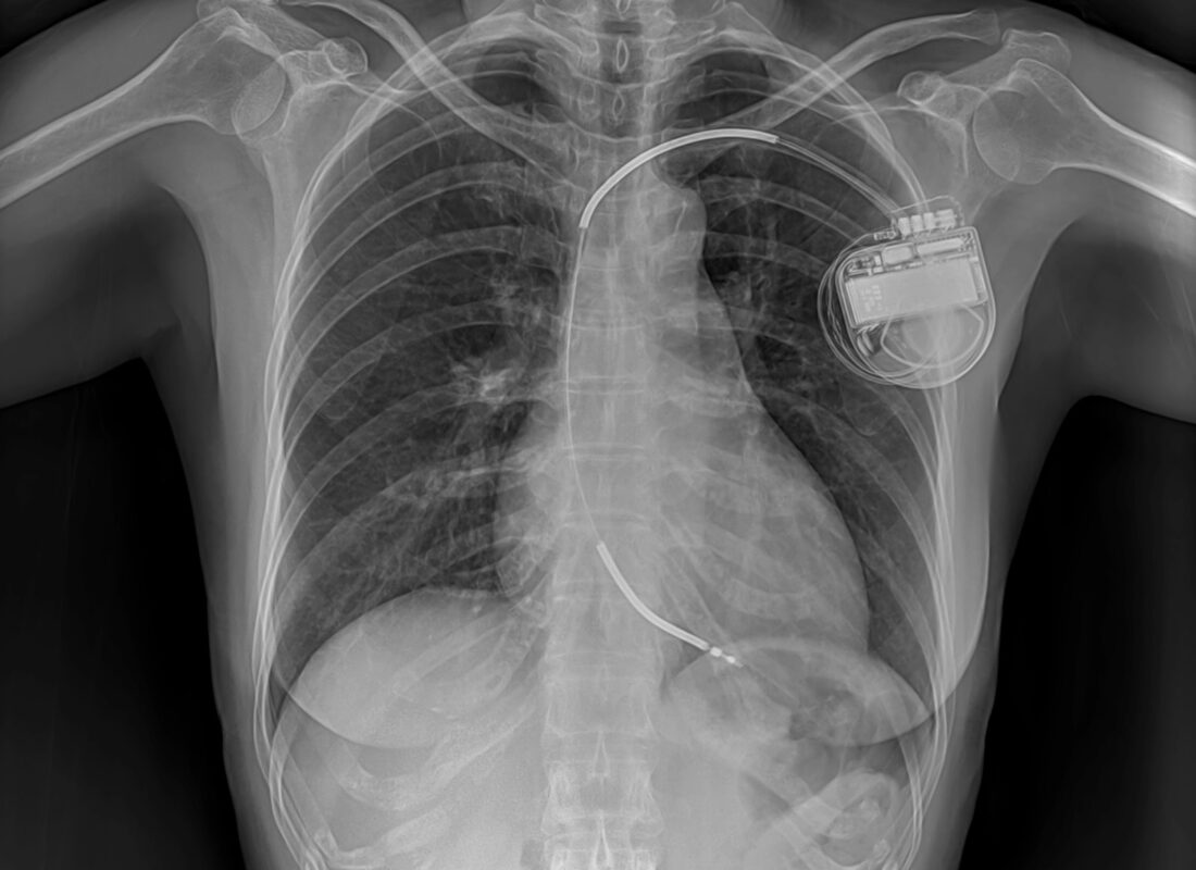 Röntgenbild Herzschrittmacher