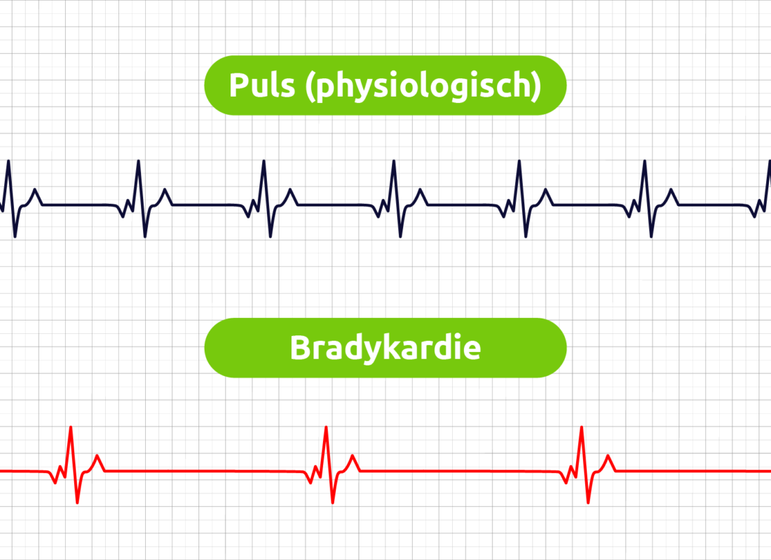 Puls Bradykardie