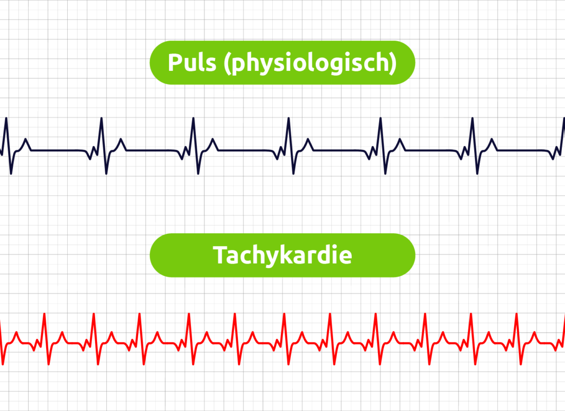 Puls Tachykardie