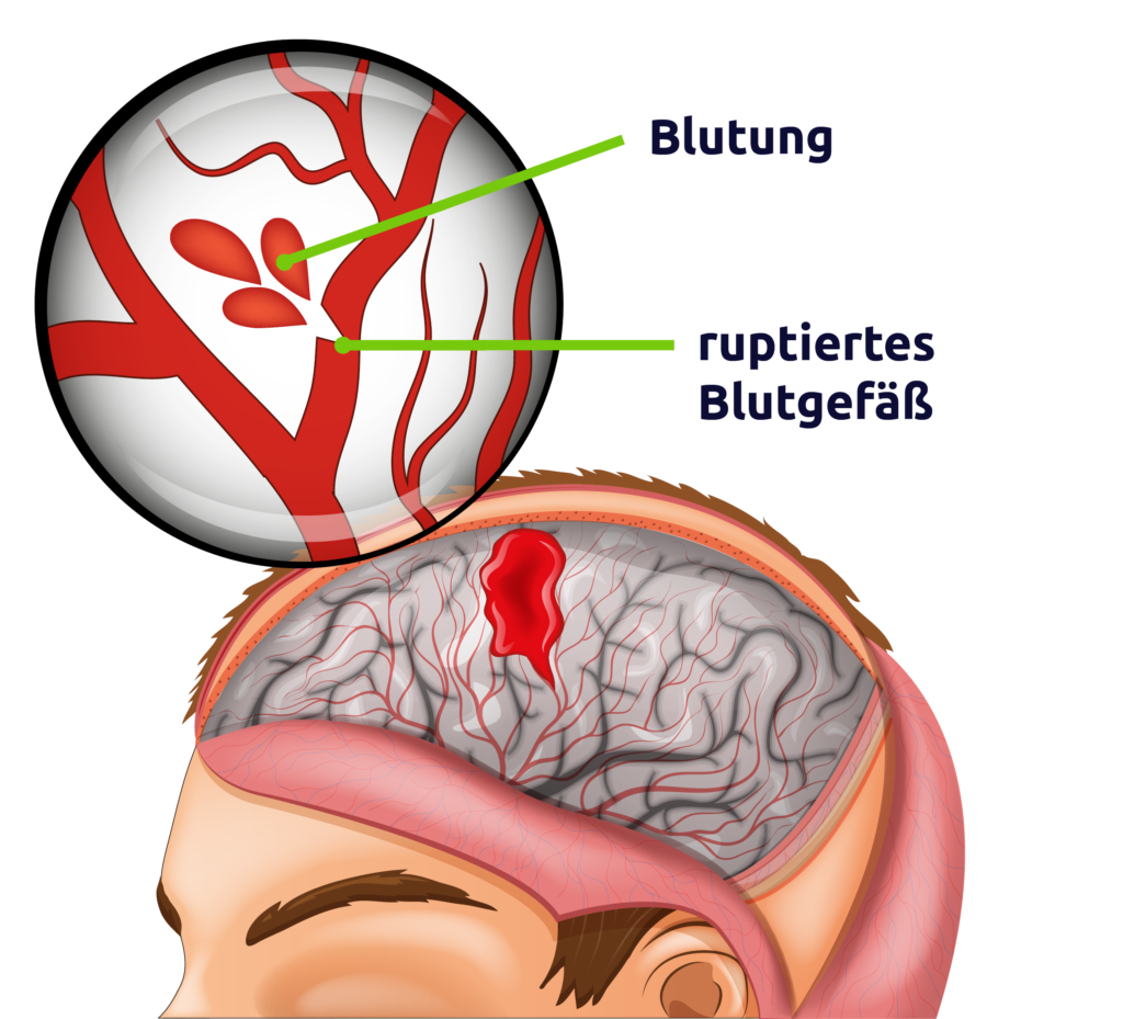 Hämorrhagischer Schlaganfall