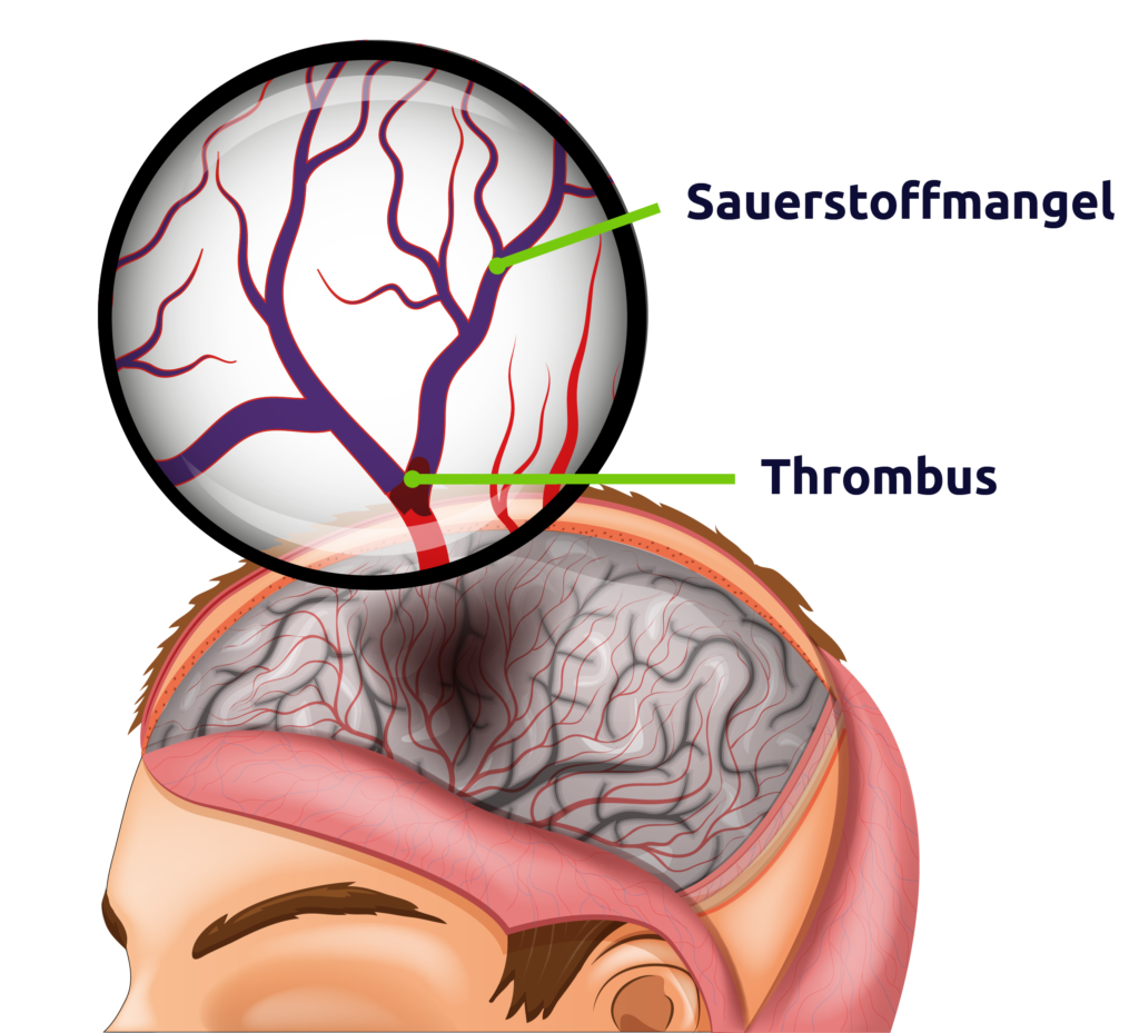 Ischämischer Schlaganfall