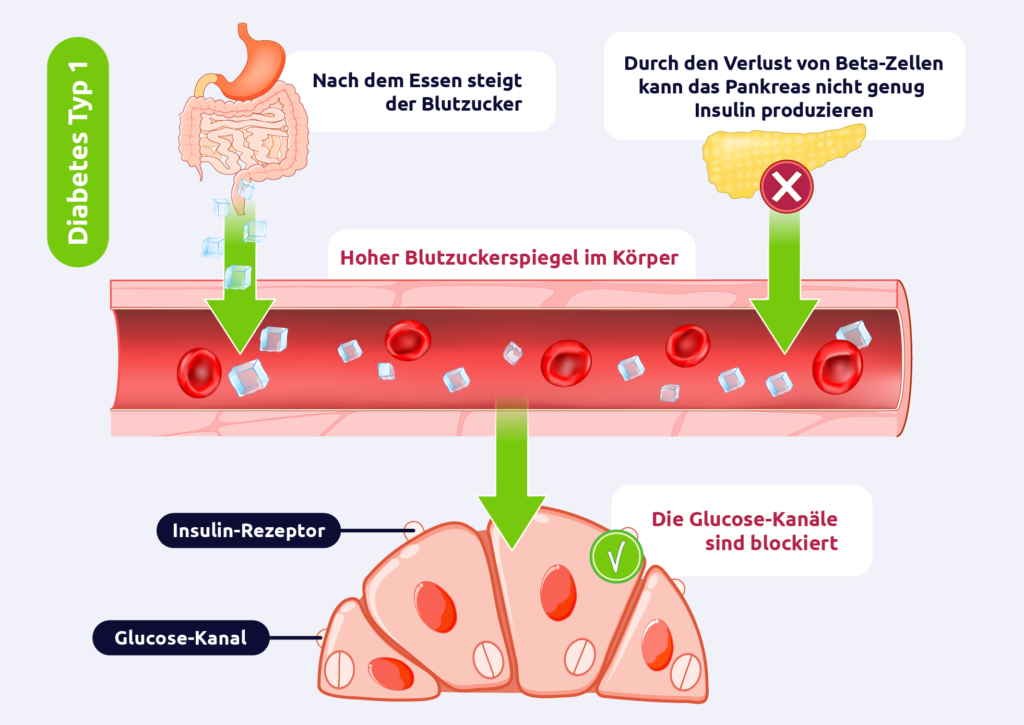 Diabetes mellitus - Typ 1