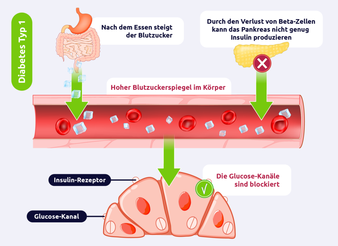 Diabetes mellitus - Typ 1