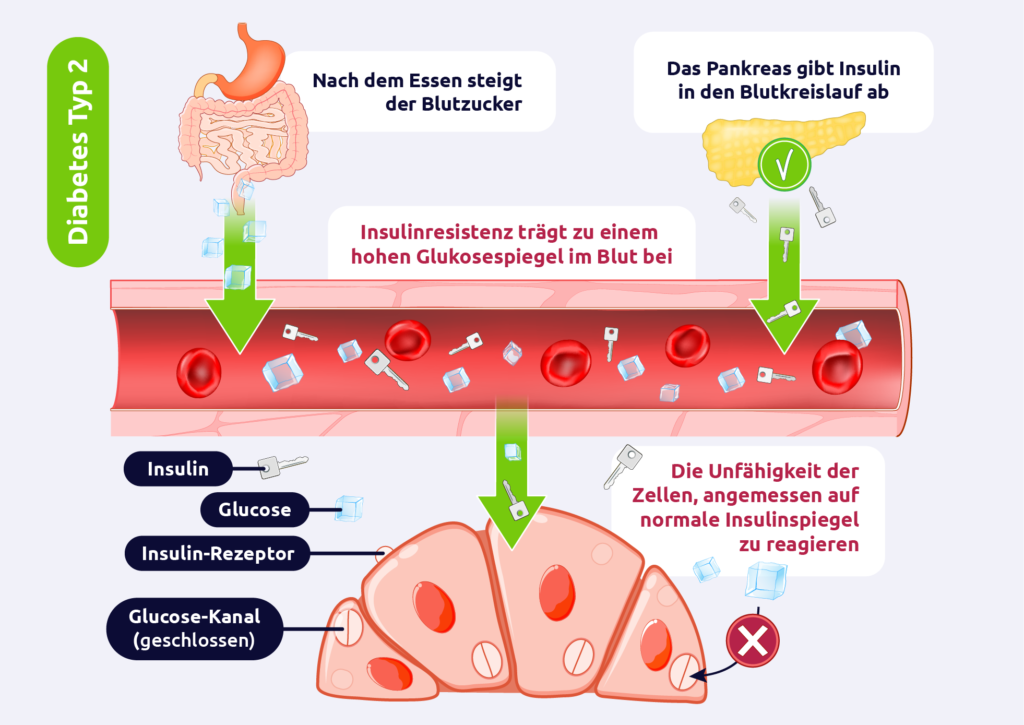 Diabetes mellitus - Typ 2