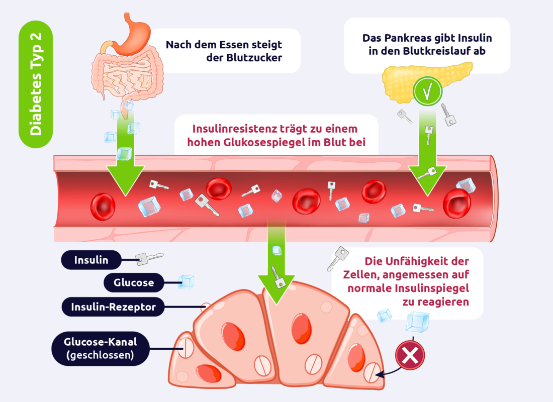 Diabetes mellitus - Typ 2