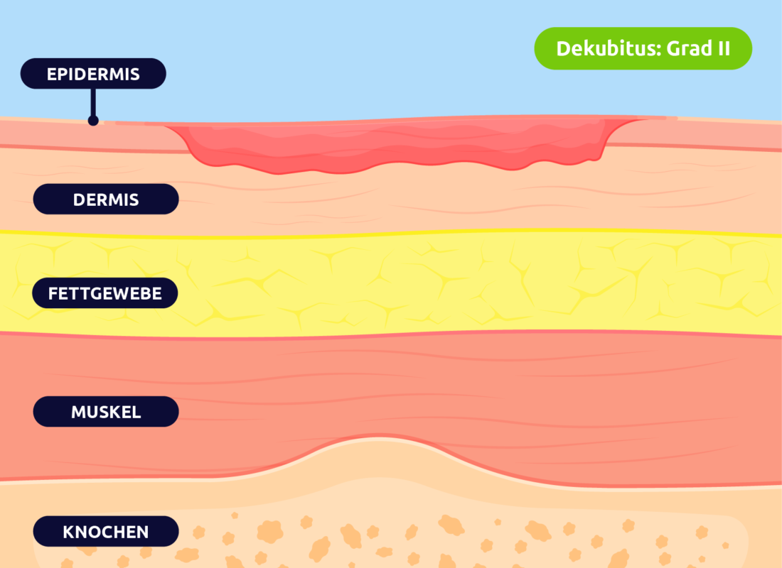 Dekubitius - Grad II