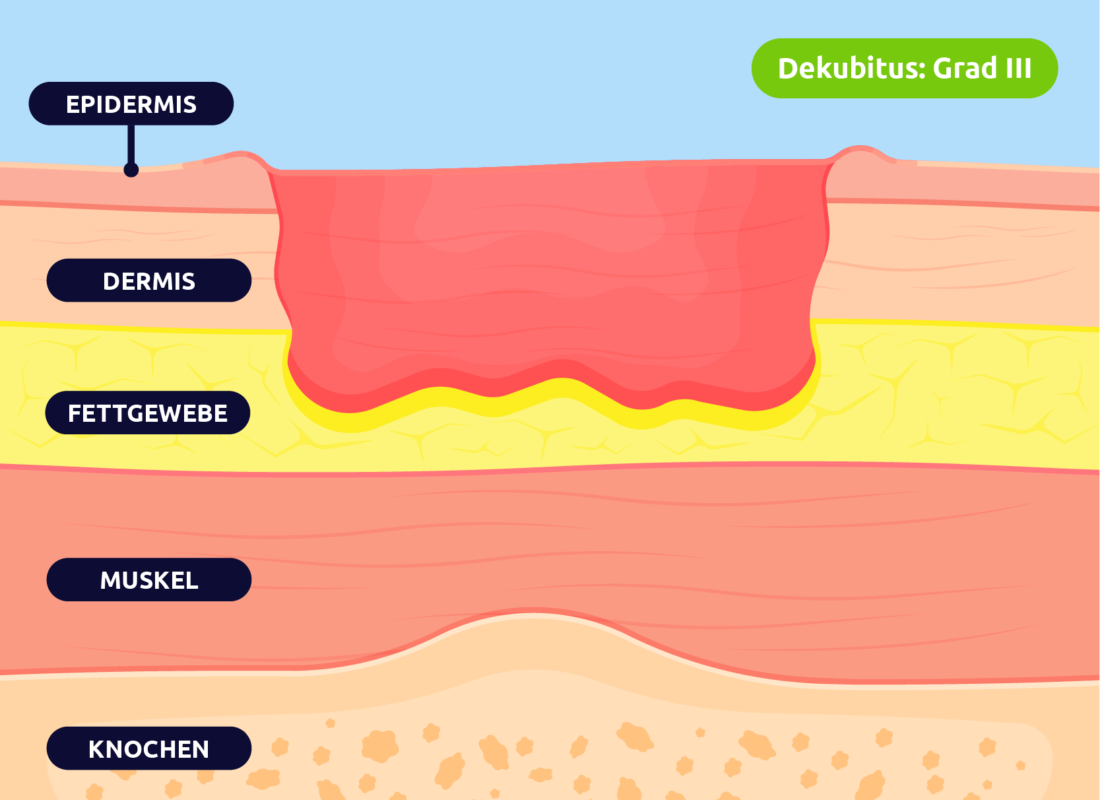 Dekubitius - Grad III