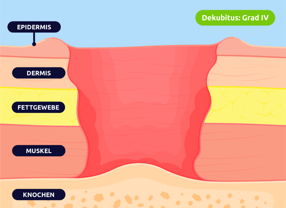 Dekubitius - Grad IV