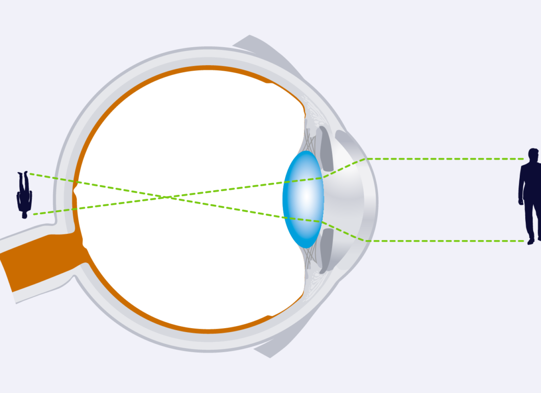 Hyperopie (Weitsichtigkeit)