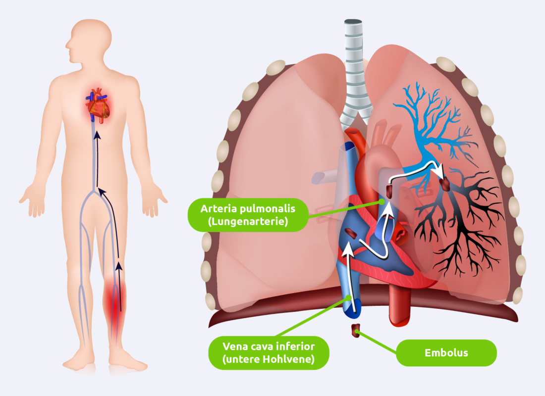 Lungenembolie